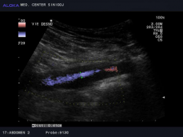 Ultrazvok žil trebuha - tromboza vene iliake eksterne